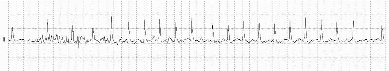 Atrial Fibrillation Rhythm Strip_fig2